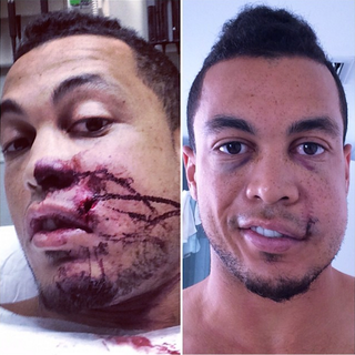 Illustration for article titled Giancarlo Stanton's Broken Face Is Improving